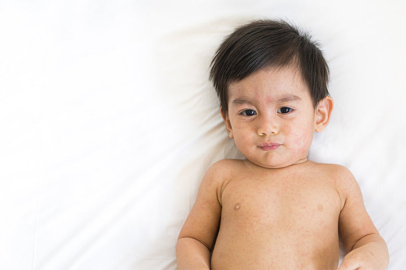 Baby Hives: What Causes Them & How To Prevent Them - Tabeeze